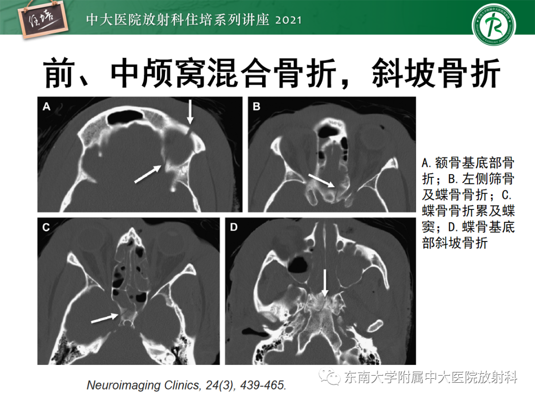 影像PPT - 【PPT】中颅窝底解剖结构及常见骨折征象-19