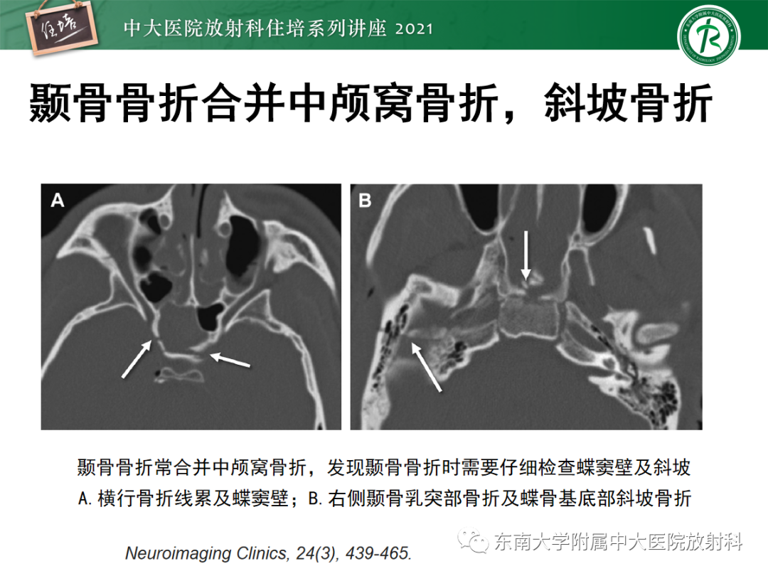 影像PPT - 【PPT】中颅窝底解剖结构及常见骨折征象-20