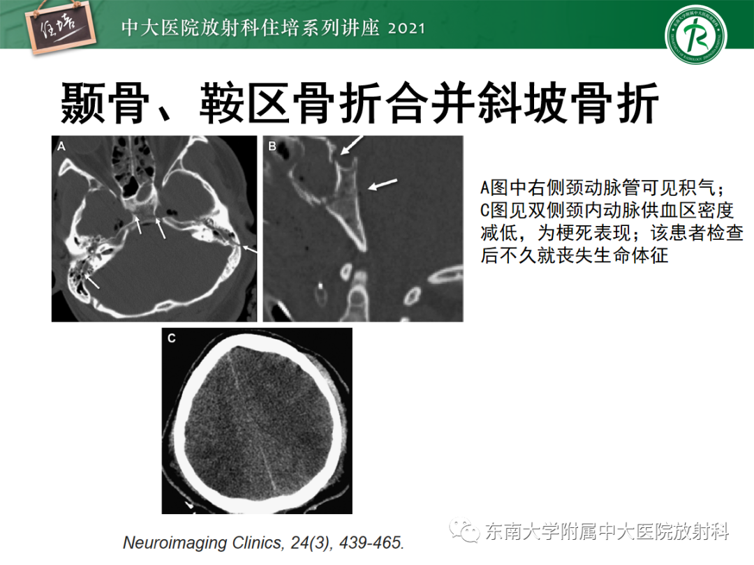 影像PPT - 【PPT】中颅窝底解剖结构及常见骨折征象-21
