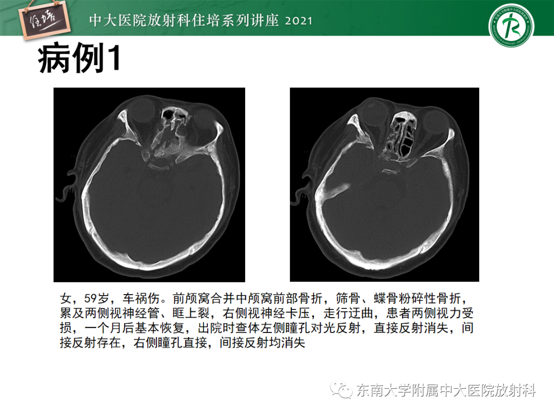 影像PPT - 【PPT】中颅窝底解剖结构及常见骨折征象-22
