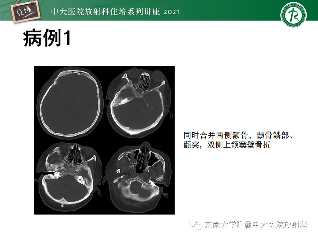 影像PPT - 【PPT】中颅窝底解剖结构及常见骨折征象-23