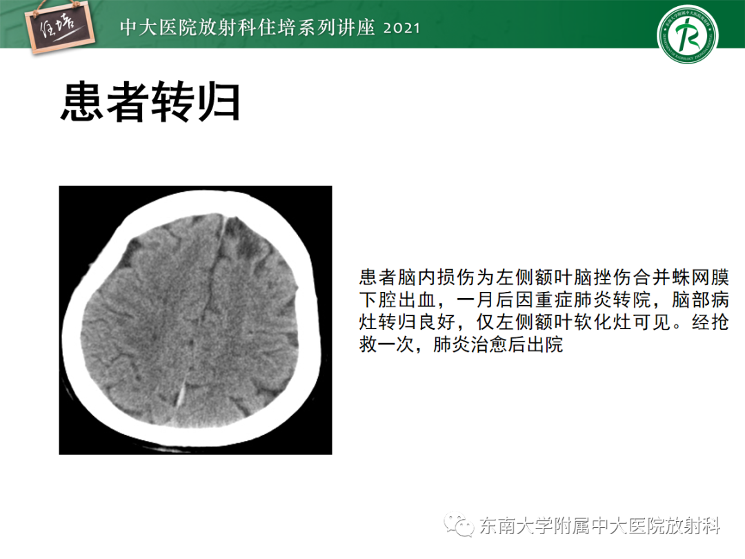 影像PPT - 【PPT】中颅窝底解剖结构及常见骨折征象-24