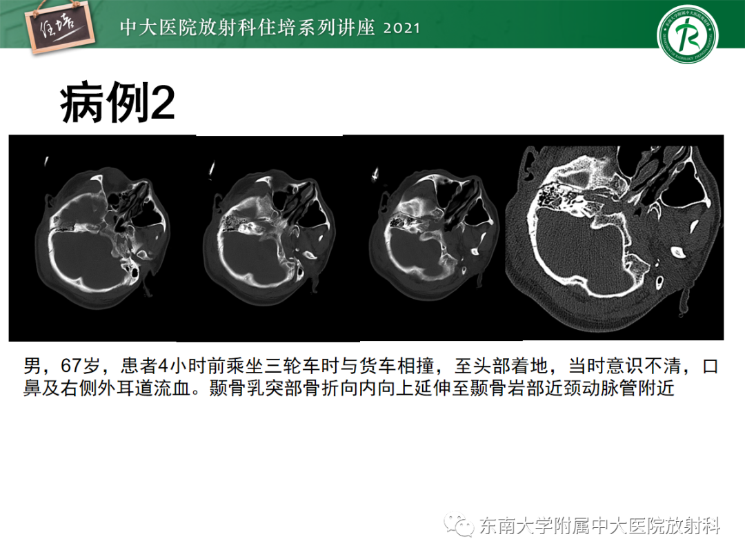 影像PPT - 【PPT】中颅窝底解剖结构及常见骨折征象-25