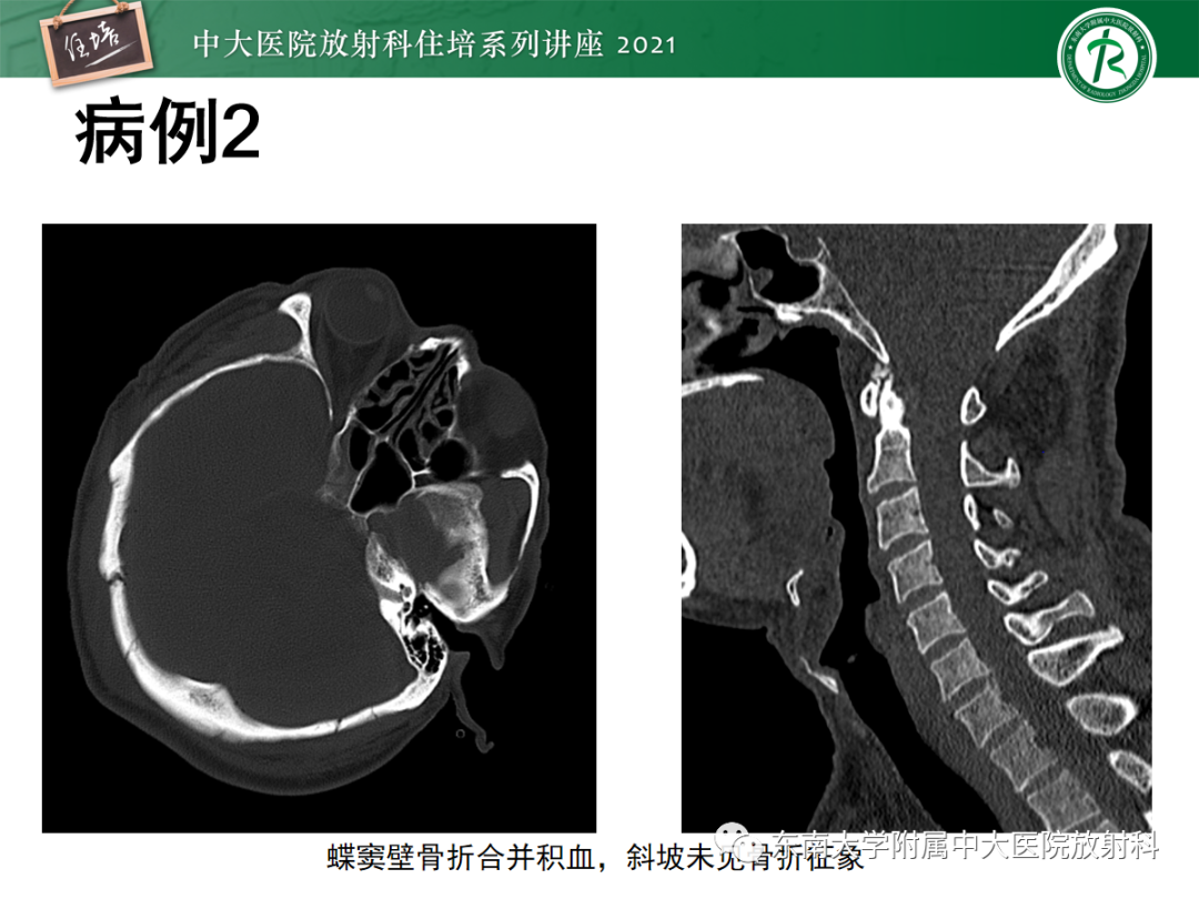 影像PPT - 【PPT】中颅窝底解剖结构及常见骨折征象-26