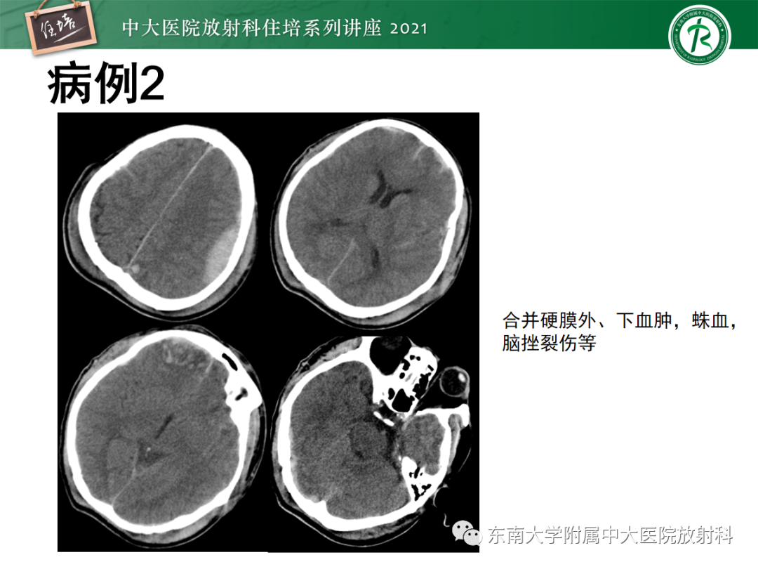 影像PPT - 【PPT】中颅窝底解剖结构及常见骨折征象-27