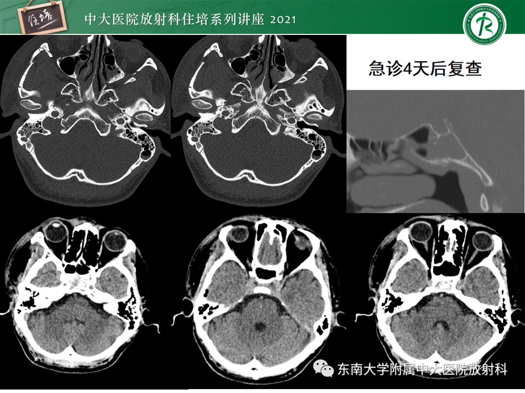影像PPT - 【PPT】中颅窝底解剖结构及常见骨折征象-30