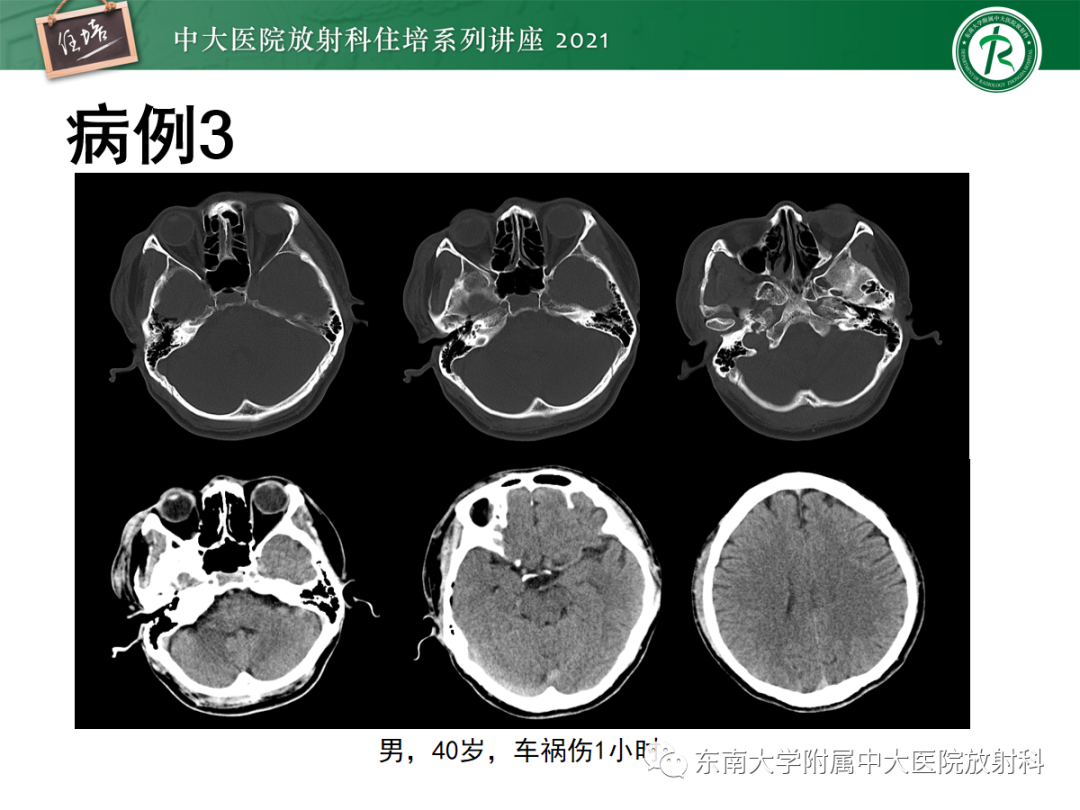 影像PPT - 【PPT】中颅窝底解剖结构及常见骨折征象-29