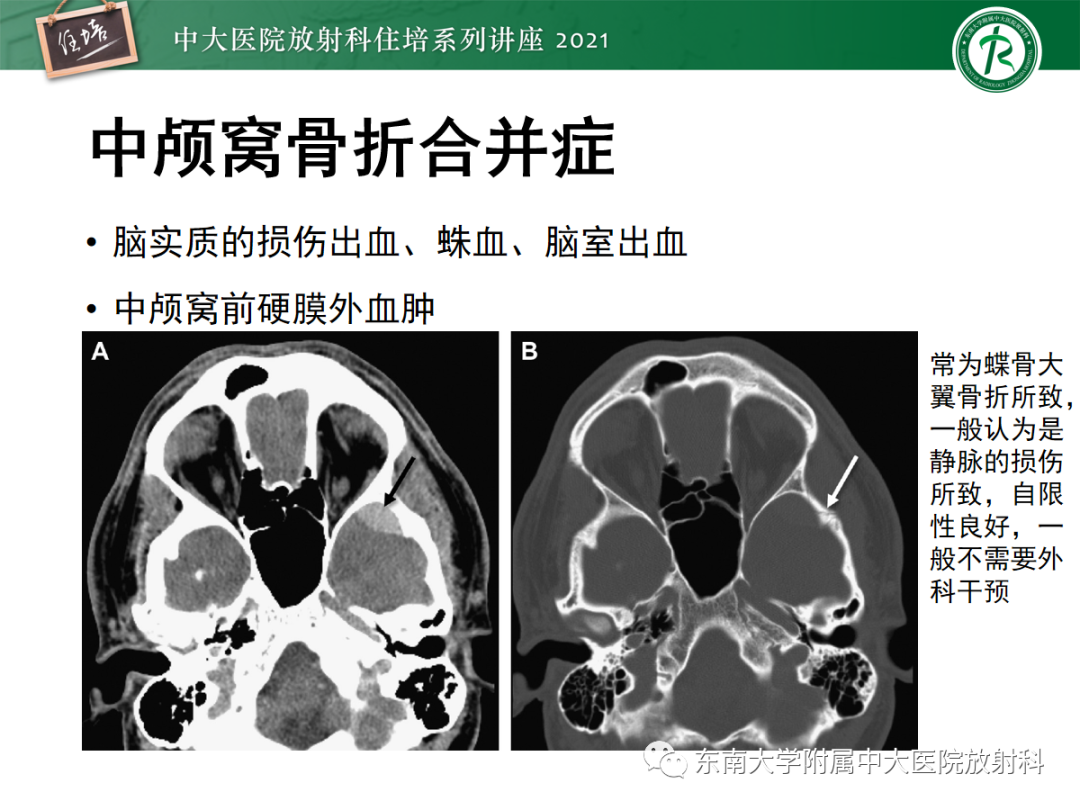 影像PPT - 【PPT】中颅窝底解剖结构及常见骨折征象-31