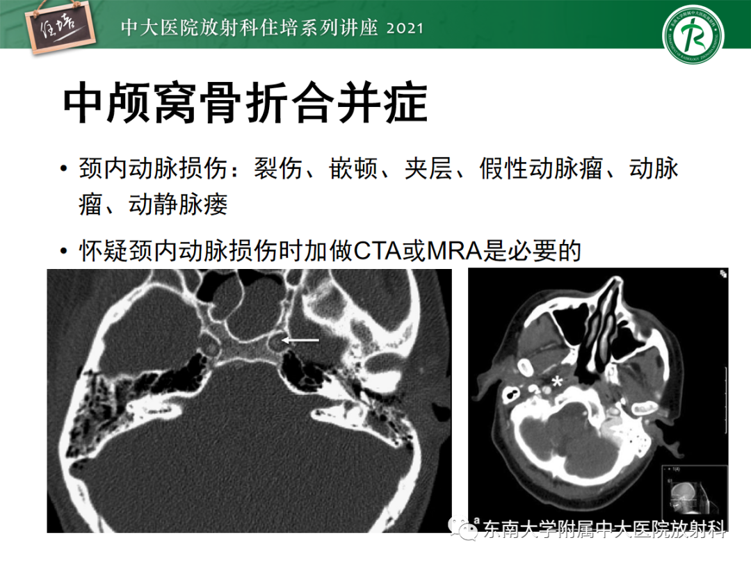 影像PPT - 【PPT】中颅窝底解剖结构及常见骨折征象-32