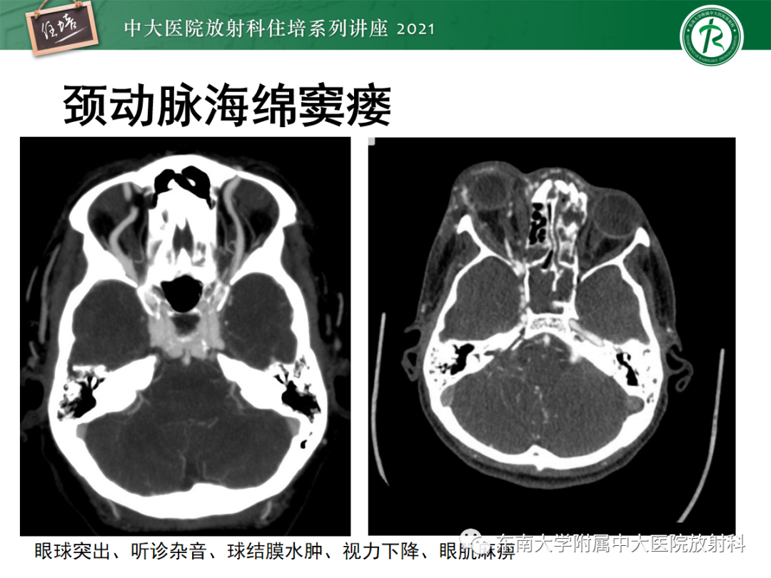 影像PPT - 【PPT】中颅窝底解剖结构及常见骨折征象-33