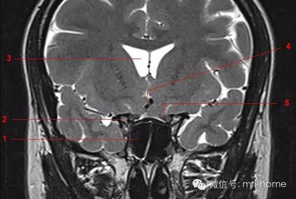 影像PPT - 鞍区、垂体磁共振(MRI)冠状面解剖-1 影像PPT - 鞍区、垂体磁共振(MRI)冠状面解剖-1