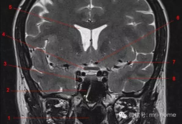影像PPT - 鞍区、垂体磁共振(MRI)冠状面解剖-4 影像PPT - 鞍区、垂体磁共振(MRI)冠状面解剖-4