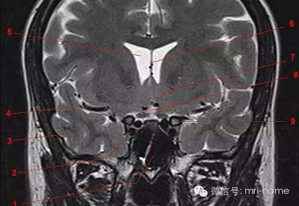 影像PPT - 鞍区、垂体磁共振(MRI)冠状面解剖-3 影像PPT - 鞍区、垂体磁共振(MRI)冠状面解剖-3