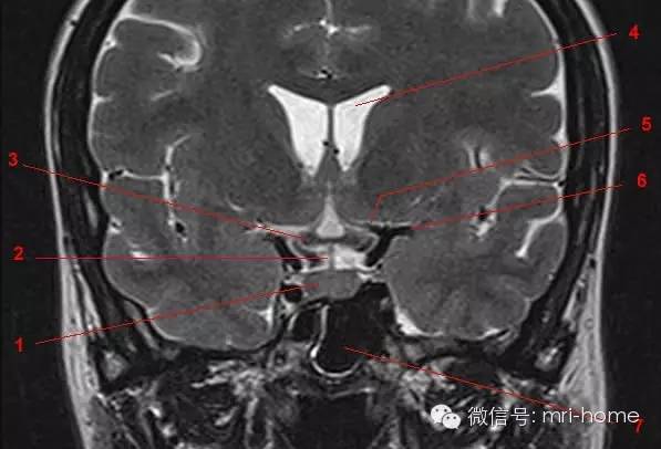 影像PPT - 鞍区、垂体磁共振(MRI)冠状面解剖-6 影像PPT - 鞍区、垂体磁共振(MRI)冠状面解剖-6