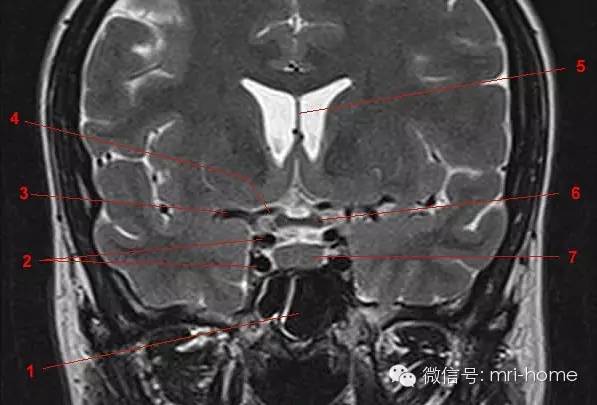 影像PPT - 鞍区、垂体磁共振(MRI)冠状面解剖-5 影像PPT - 鞍区、垂体磁共振(MRI)冠状面解剖-5