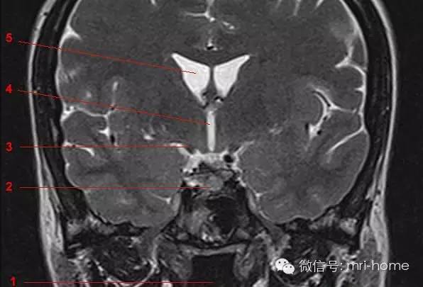 影像PPT - 鞍区、垂体磁共振(MRI)冠状面解剖-8 影像PPT - 鞍区、垂体磁共振(MRI)冠状面解剖-8