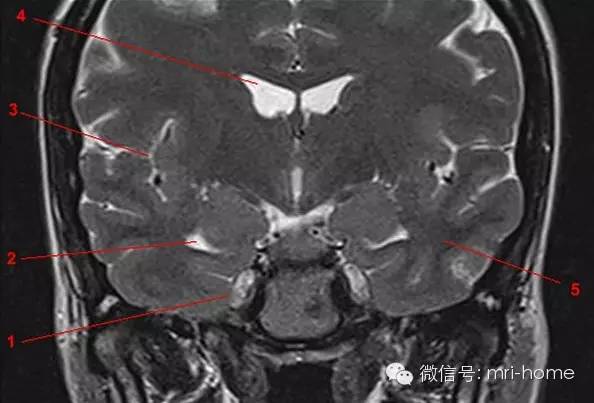 影像PPT - 鞍区、垂体磁共振(MRI)冠状面解剖-10 影像PPT - 鞍区、垂体磁共振(MRI)冠状面解剖-10