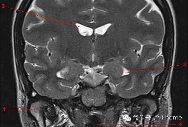 影像PPT - 鞍区、垂体磁共振(MRI)冠状面解剖-11 影像PPT - 鞍区、垂体磁共振(MRI)冠状面解剖-11
