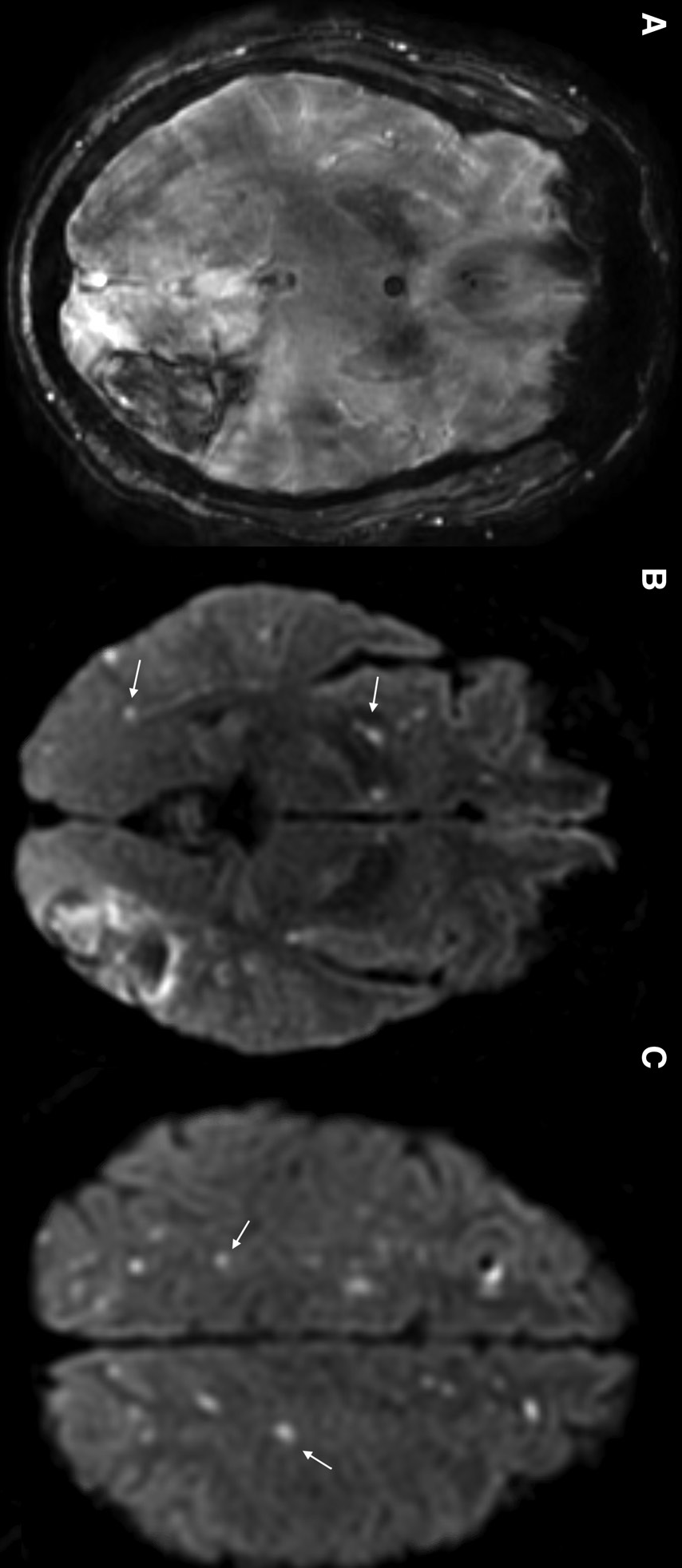影像PPT - Stroke:近一半的脑出血患者可以检测到DWI缺血病变-1 影像PPT - Stroke:近一半的脑出血患者可以检测到DWI缺血病变-1