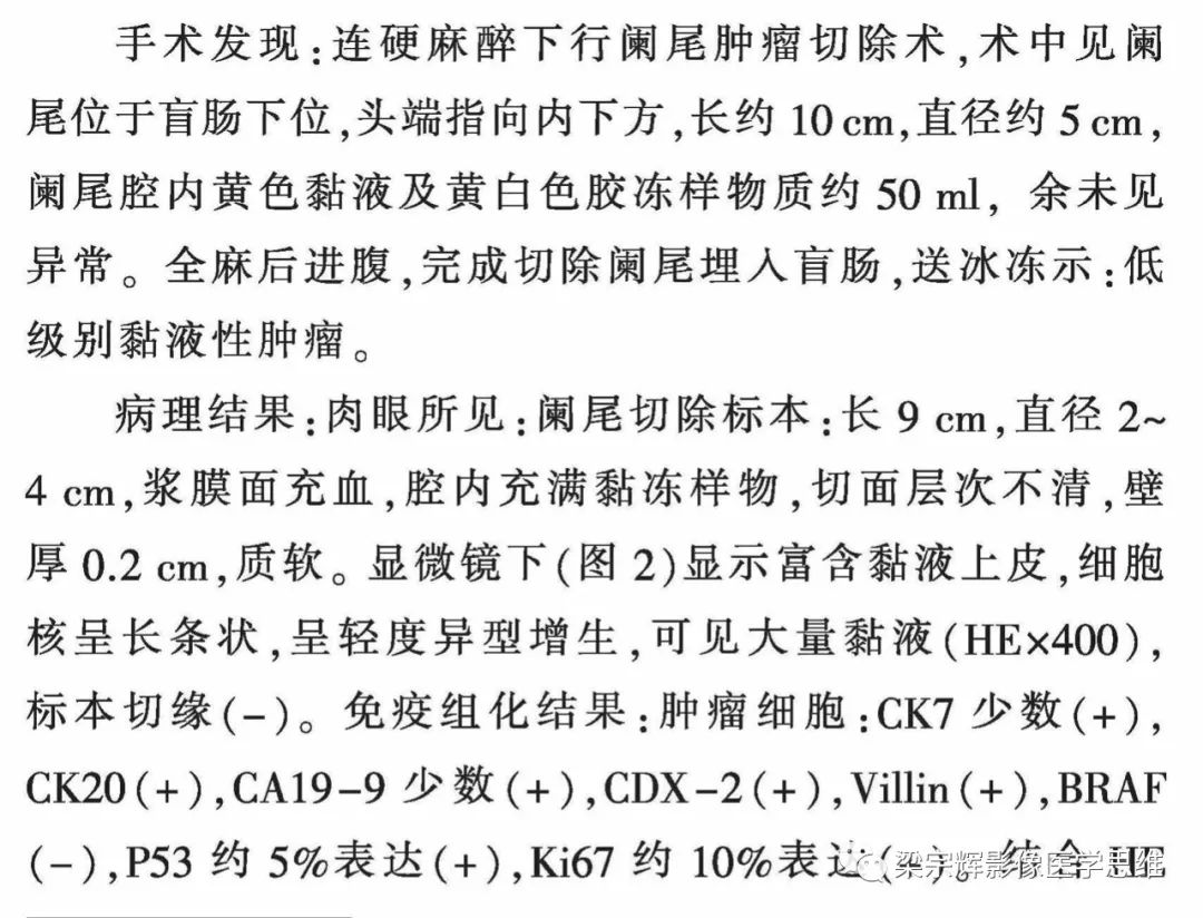 影像PPT - 【病例】阑尾粘液性肿瘤1例CT影像诊断思维-5