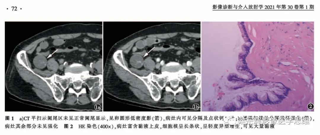 影像PPT - 【病例】阑尾粘液性肿瘤1例CT影像诊断思维-4