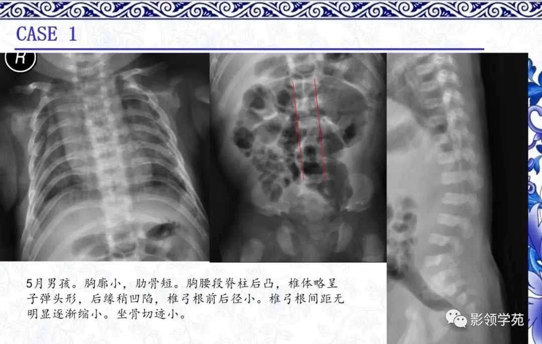 影像PPT - 【PPT】常见骨软骨发育异常的X线表现-2 影像PPT - 【PPT】常见骨软骨发育异常的X线表现-2