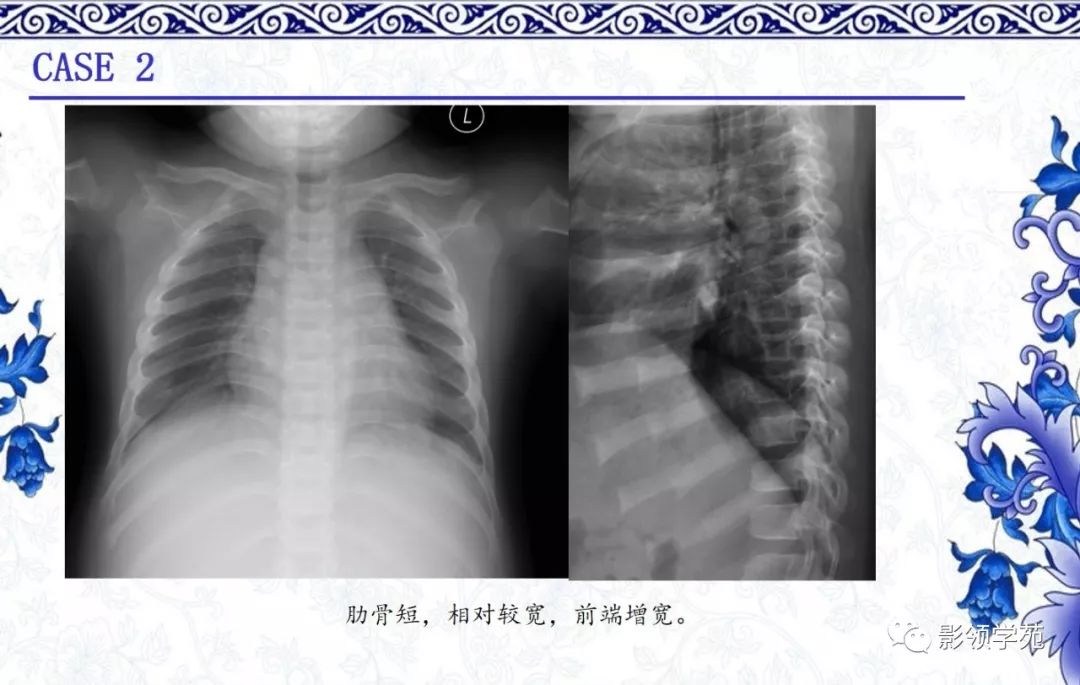 影像PPT - 【PPT】常见骨软骨发育异常的X线表现-6 影像PPT - 【PPT】常见骨软骨发育异常的X线表现-6
