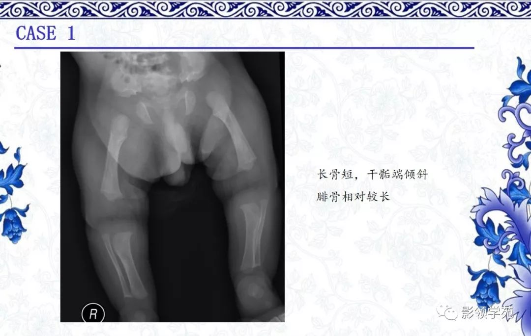 影像PPT - 【PPT】常见骨软骨发育异常的X线表现-3 影像PPT - 【PPT】常见骨软骨发育异常的X线表现-3