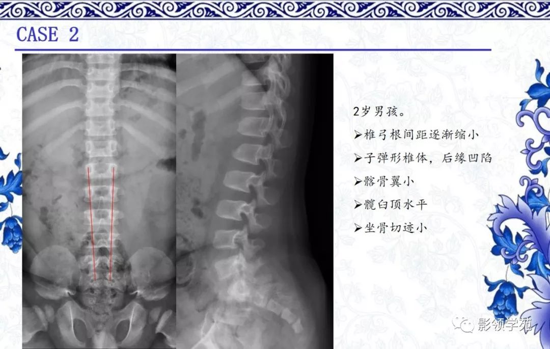 影像PPT - 【PPT】常见骨软骨发育异常的X线表现-4 影像PPT - 【PPT】常见骨软骨发育异常的X线表现-4