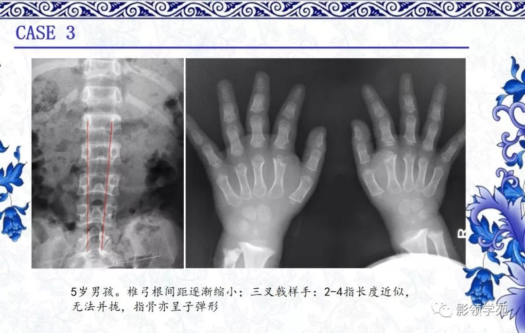 影像PPT - 【PPT】常见骨软骨发育异常的X线表现-7 影像PPT - 【PPT】常见骨软骨发育异常的X线表现-7