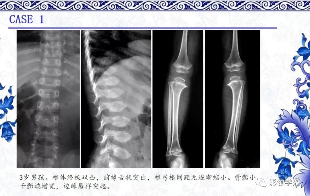 影像PPT - 【PPT】常见骨软骨发育异常的X线表现-10 影像PPT - 【PPT】常见骨软骨发育异常的X线表现-10