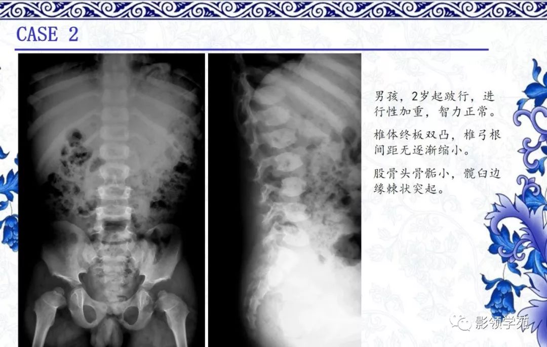 影像PPT - 【PPT】常见骨软骨发育异常的X线表现-11 影像PPT - 【PPT】常见骨软骨发育异常的X线表现-11