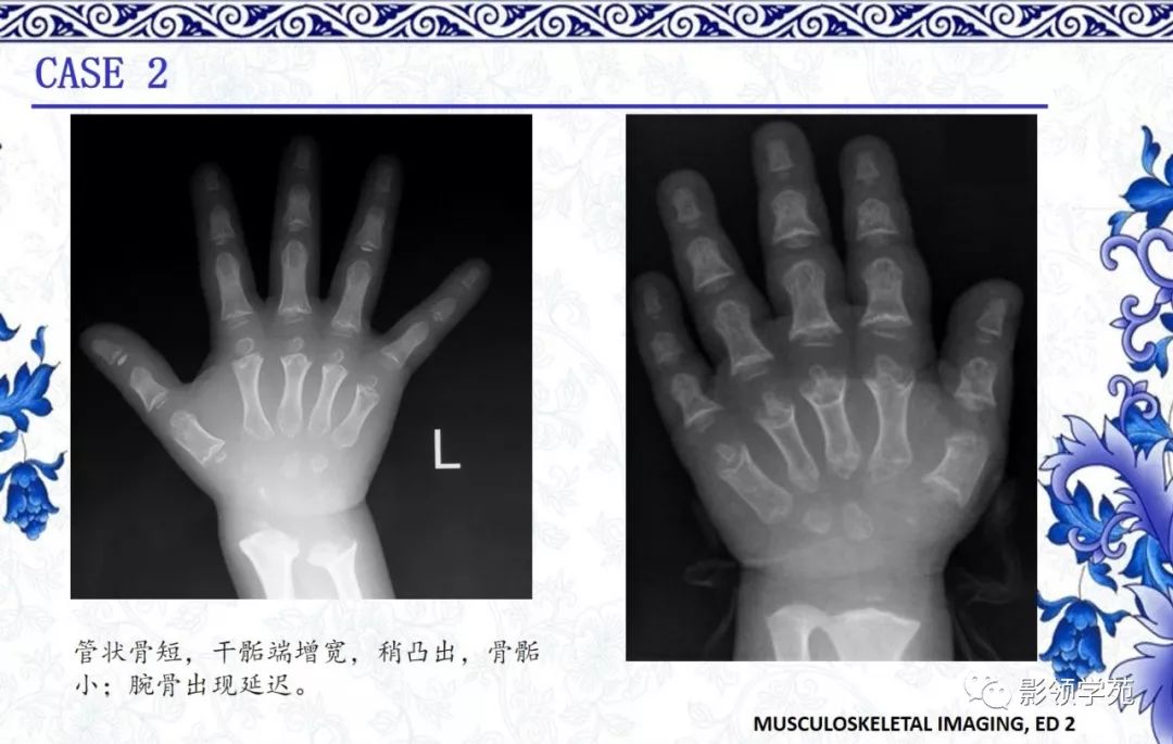 影像PPT - 【PPT】常见骨软骨发育异常的X线表现-13 影像PPT - 【PPT】常见骨软骨发育异常的X线表现-13