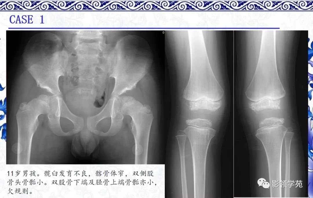 影像PPT - 【PPT】常见骨软骨发育异常的X线表现-16 影像PPT - 【PPT】常见骨软骨发育异常的X线表现-16