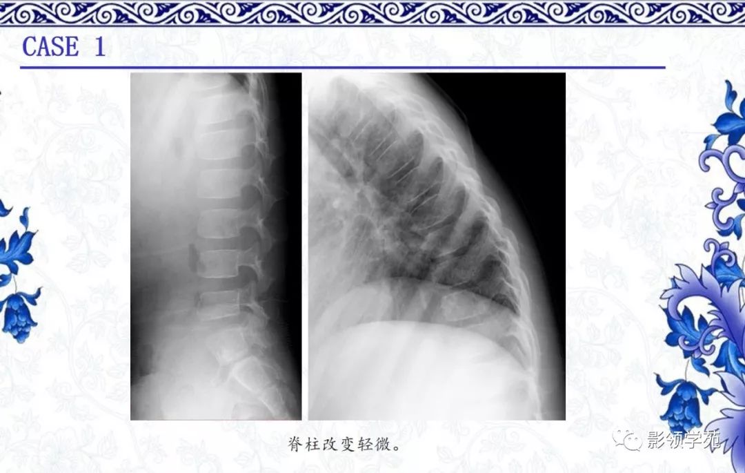 影像PPT - 【PPT】常见骨软骨发育异常的X线表现-17 影像PPT - 【PPT】常见骨软骨发育异常的X线表现-17