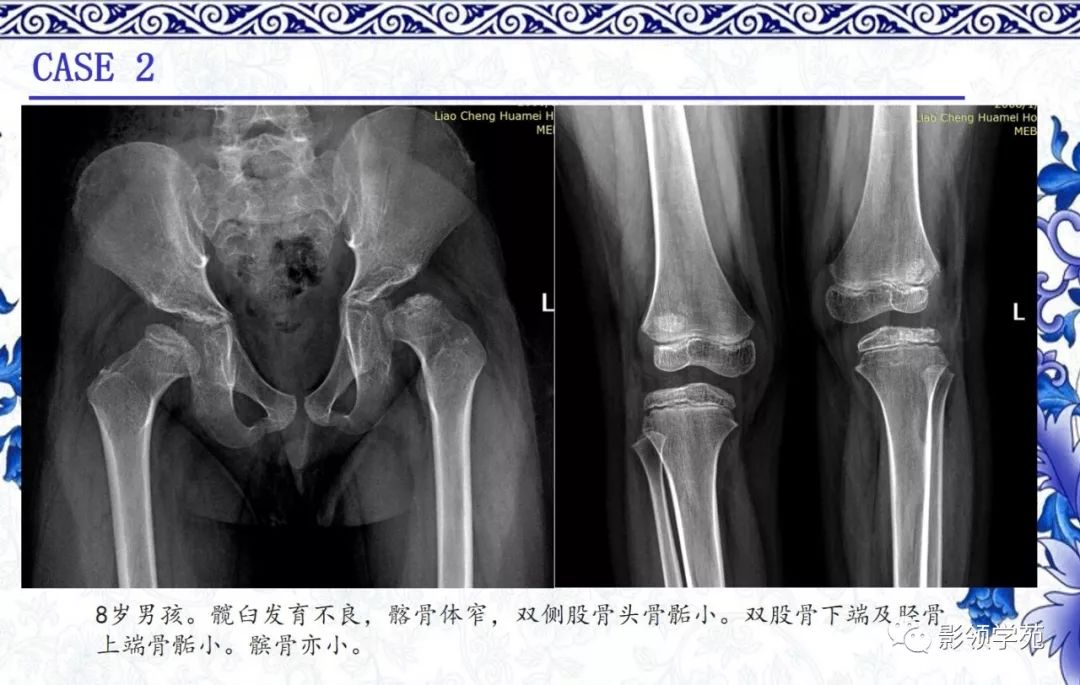 影像PPT - 【PPT】常见骨软骨发育异常的X线表现-18 影像PPT - 【PPT】常见骨软骨发育异常的X线表现-18