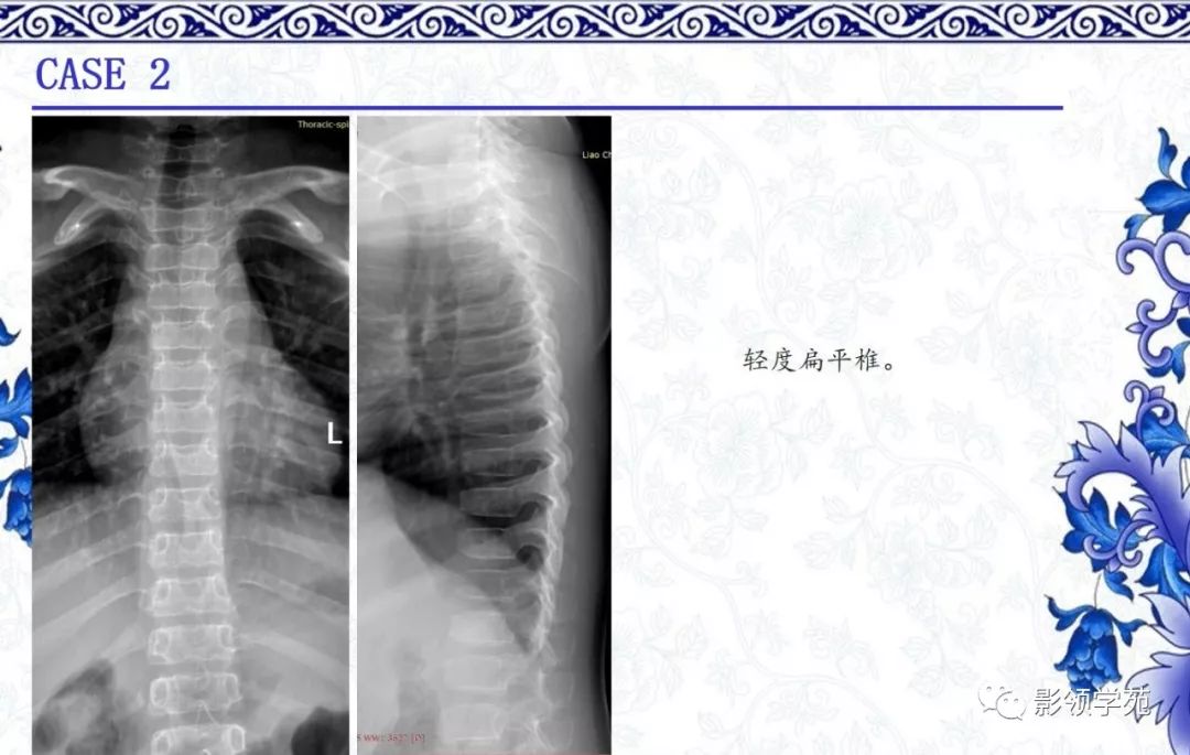 影像PPT - 【PPT】常见骨软骨发育异常的X线表现-19 影像PPT - 【PPT】常见骨软骨发育异常的X线表现-19
