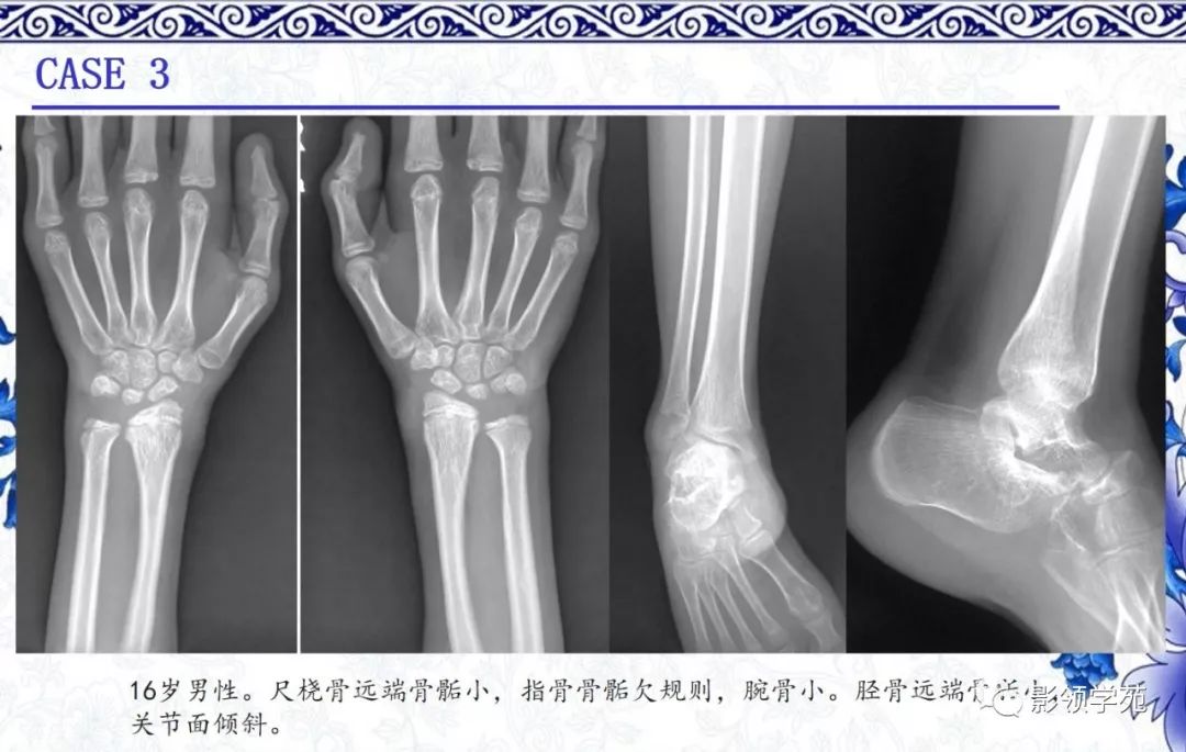 影像PPT - 【PPT】常见骨软骨发育异常的X线表现-20 影像PPT - 【PPT】常见骨软骨发育异常的X线表现-20