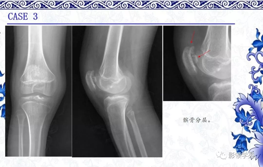 影像PPT - 【PPT】常见骨软骨发育异常的X线表现-21 影像PPT - 【PPT】常见骨软骨发育异常的X线表现-21