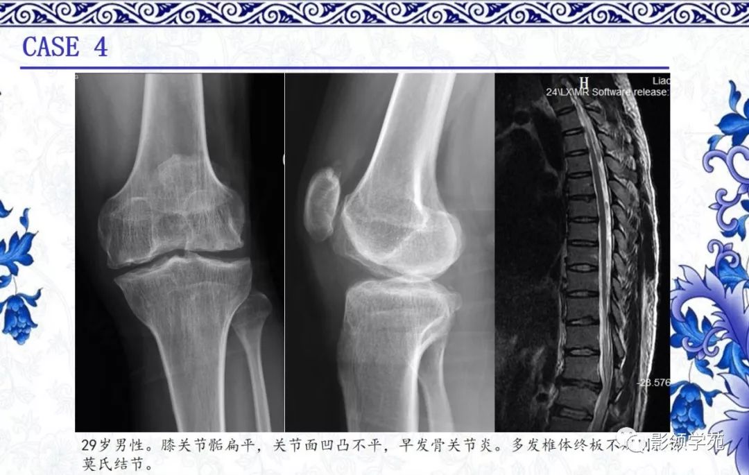 影像PPT - 【PPT】常见骨软骨发育异常的X线表现-22 影像PPT - 【PPT】常见骨软骨发育异常的X线表现-22