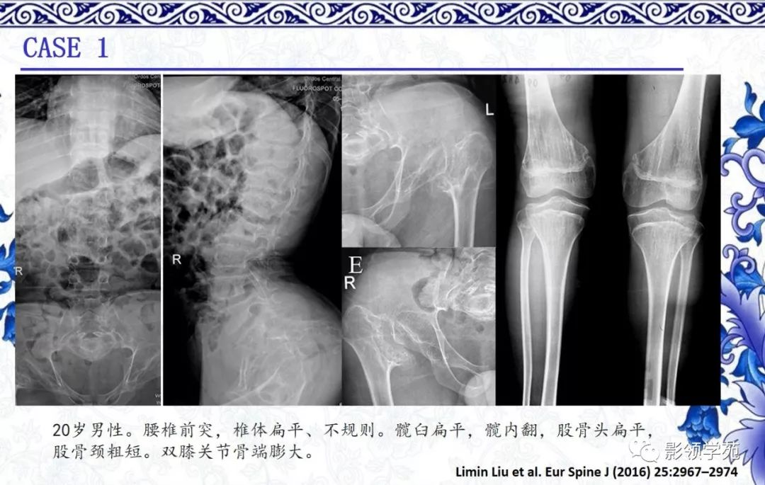 影像PPT - 【PPT】常见骨软骨发育异常的X线表现-25 影像PPT - 【PPT】常见骨软骨发育异常的X线表现-25