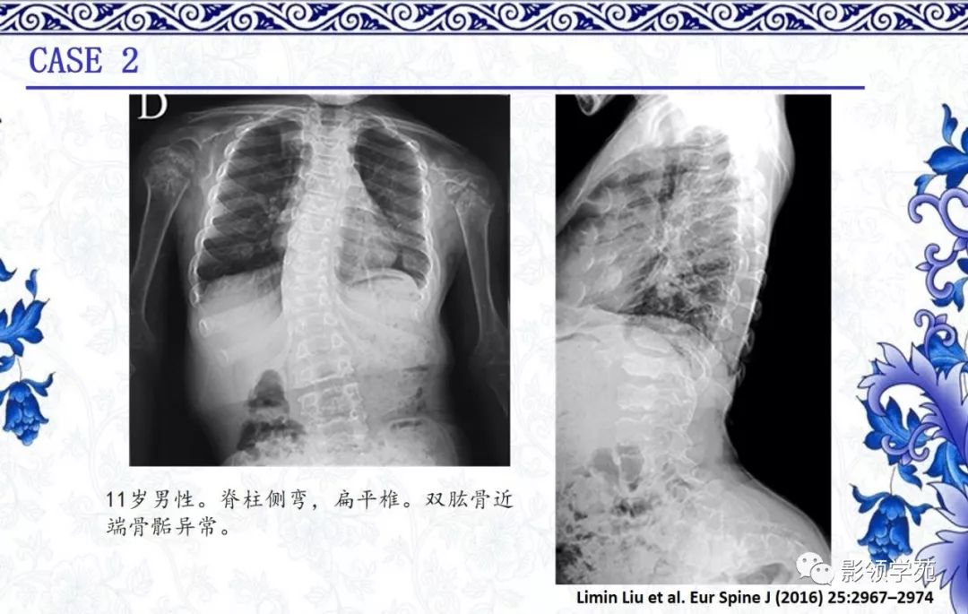 影像PPT - 【PPT】常见骨软骨发育异常的X线表现-26 影像PPT - 【PPT】常见骨软骨发育异常的X线表现-26