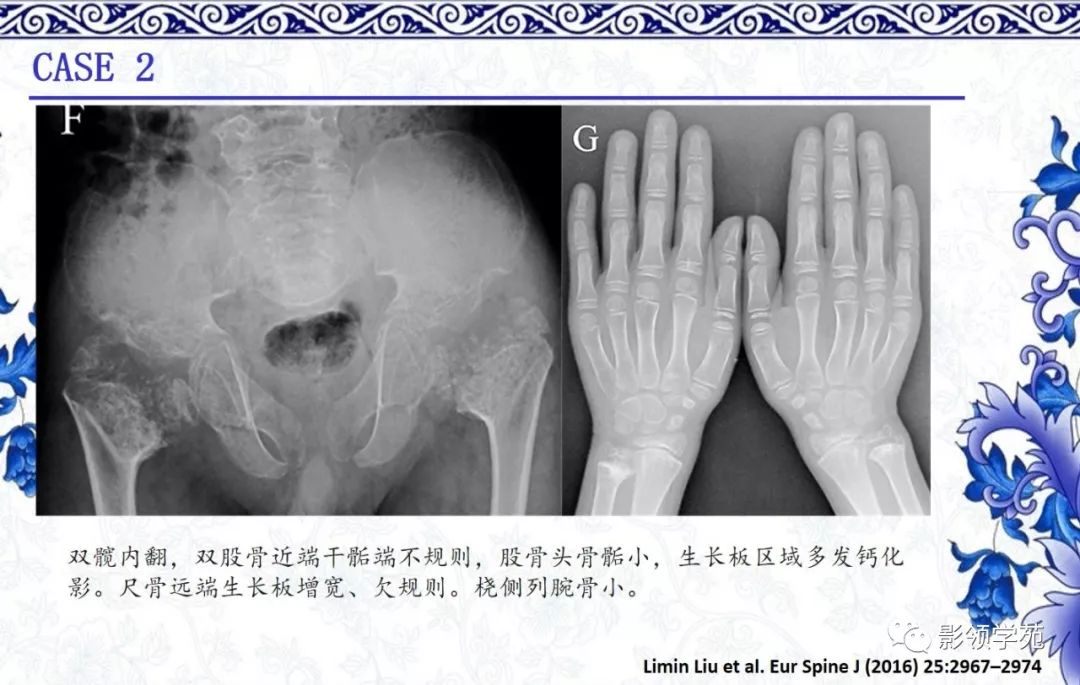 影像PPT - 【PPT】常见骨软骨发育异常的X线表现-27 影像PPT - 【PPT】常见骨软骨发育异常的X线表现-27