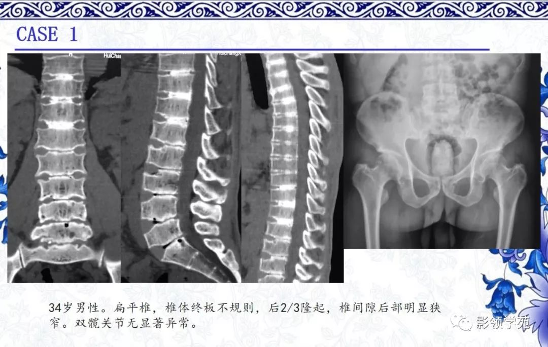 影像PPT - 【PPT】常见骨软骨发育异常的X线表现-31 影像PPT - 【PPT】常见骨软骨发育异常的X线表现-31
