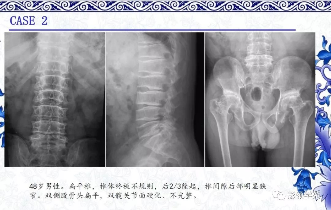 影像PPT - 【PPT】常见骨软骨发育异常的X线表现-32 影像PPT - 【PPT】常见骨软骨发育异常的X线表现-32