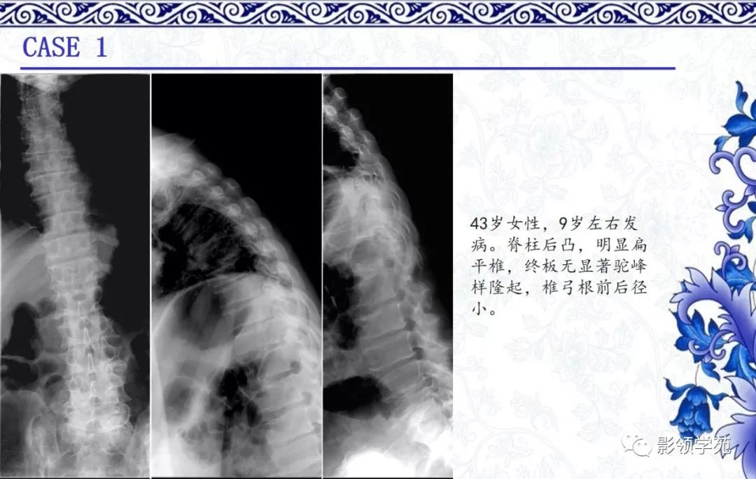 影像PPT - 【PPT】常见骨软骨发育异常的X线表现-35 影像PPT - 【PPT】常见骨软骨发育异常的X线表现-35