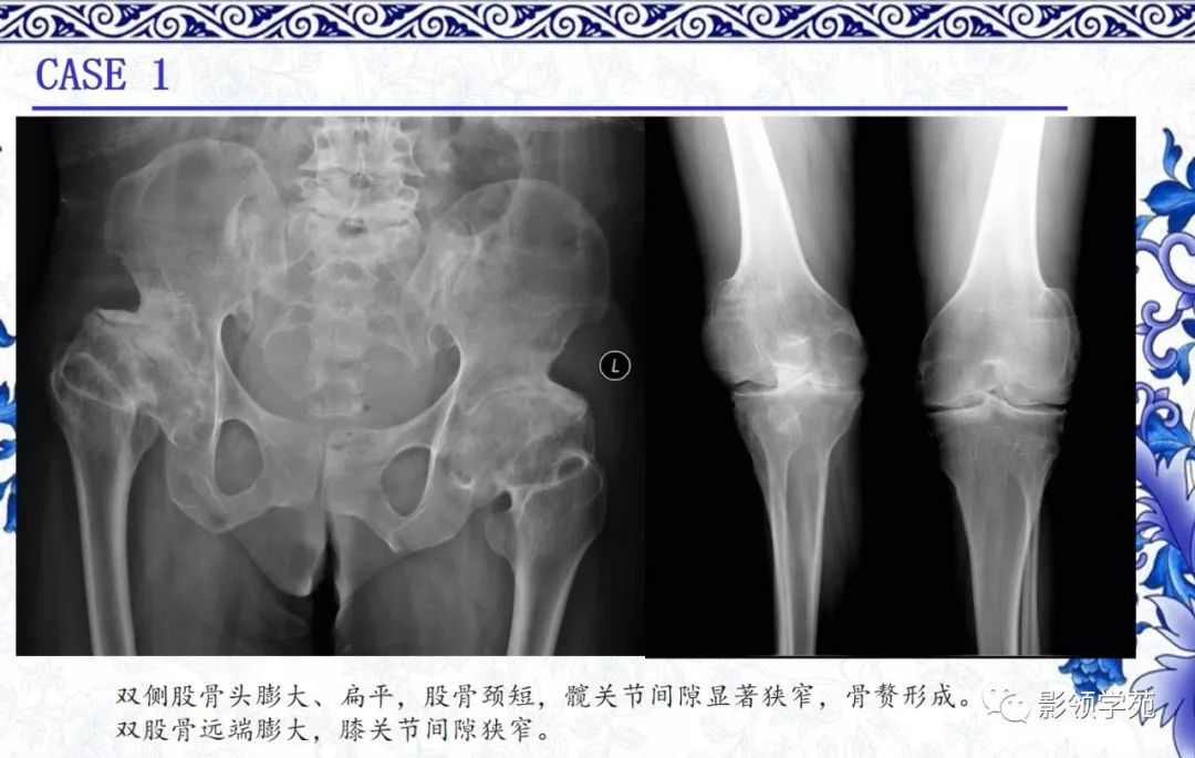 影像PPT - 【PPT】常见骨软骨发育异常的X线表现-36 影像PPT - 【PPT】常见骨软骨发育异常的X线表现-36