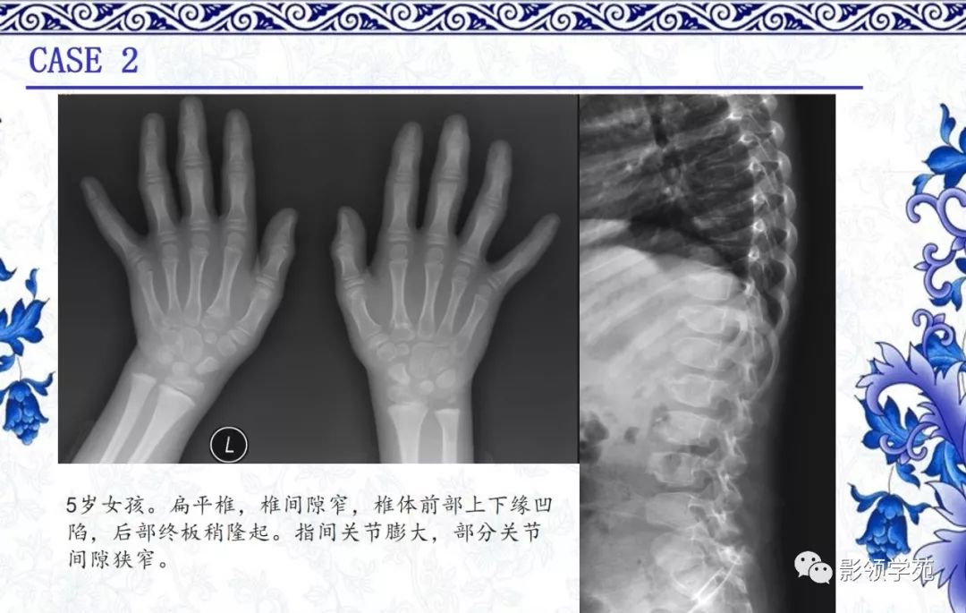 影像PPT - 【PPT】常见骨软骨发育异常的X线表现-37 影像PPT - 【PPT】常见骨软骨发育异常的X线表现-37