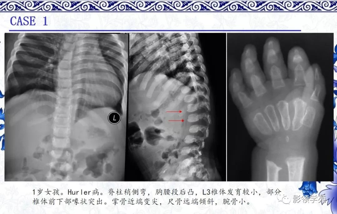 影像PPT - 【PPT】常见骨软骨发育异常的X线表现-41 影像PPT - 【PPT】常见骨软骨发育异常的X线表现-41