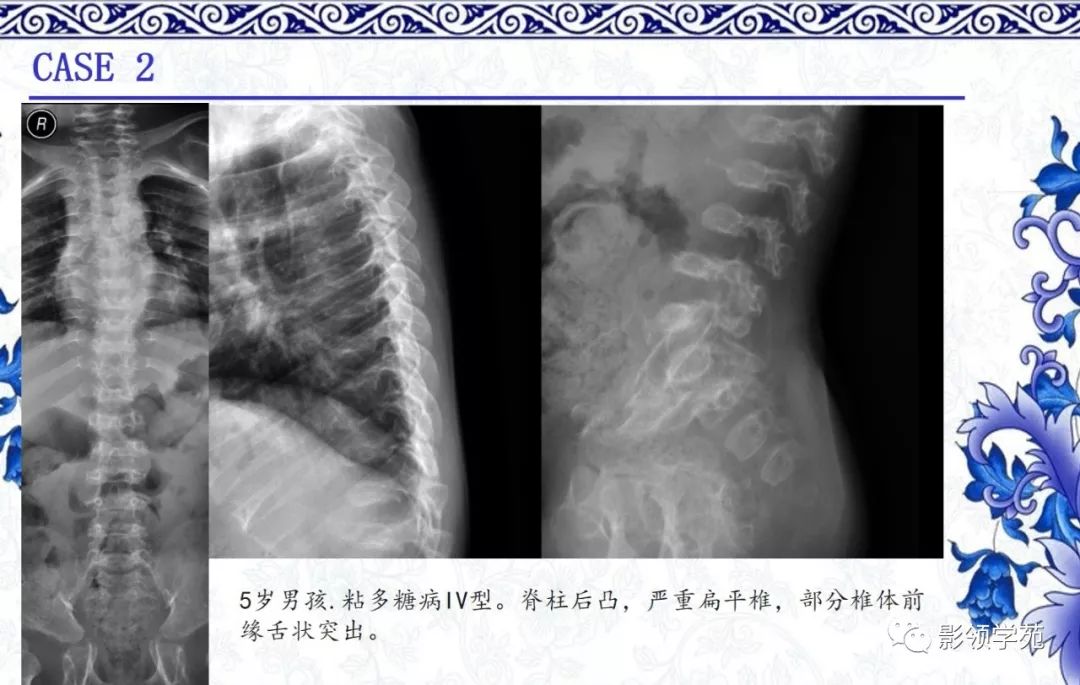 影像PPT - 【PPT】常见骨软骨发育异常的X线表现-42 影像PPT - 【PPT】常见骨软骨发育异常的X线表现-42